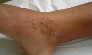 Thói quen xấu khiến thanh niên nhiễm cùng lúc 3 loại ký sinh trùng