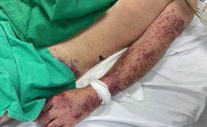 Bệnh liên cầu lợn là gì?
