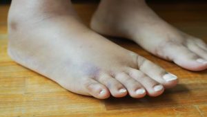 5 tín hiệu cảnh báo bệnh gan giai đoạn đầu