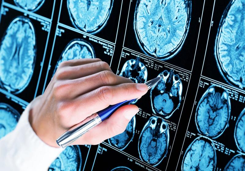 Bệnh nhân Alzheimer trẻ nhất ảnh 1 Bệnh nhân Alzheimer trẻ nhất ảnh 1