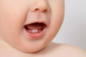 Dính thắng lưỡi ở trẻ em