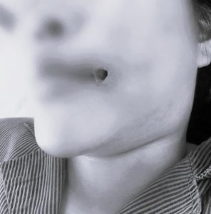 Mặt biến dạng vì hành động mạo hiểm với ổ mủ sau tiêm filler