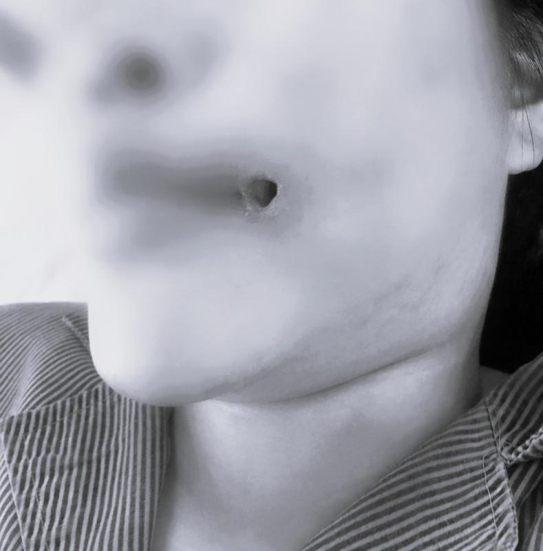 tiem filler anh 1