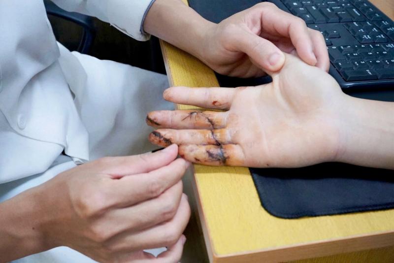 mất 3 ngón tay ảnh 1 mất 3 ngón tay ảnh 1