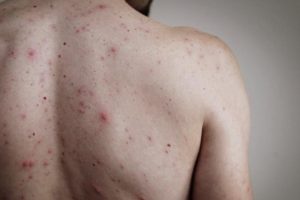 Nam thanh niên phát hiện mắc giang mai từ dấu hiệu lạ